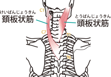 板状筋の痛み