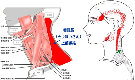 こめかみが痛い頭痛 こめかみが痛い頭痛
