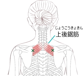 上後鋸筋の痛みと肩こり