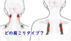 胸鎖乳突筋の痛み 胸鎖乳突筋の痛み