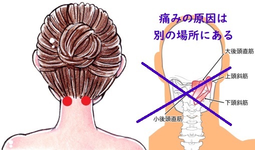 上頭斜筋の痛み?原因は別の部位
