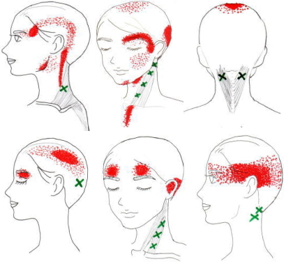 頭痛 トリガーポイント 筋肉別の症状 イラスト