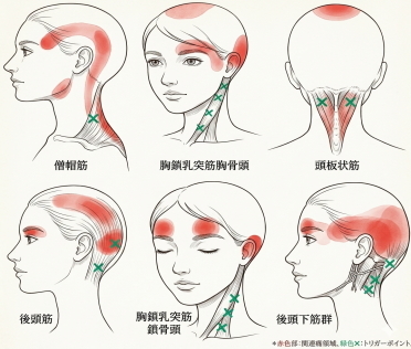 頭痛や首肩こりに関連する筋肉とトリガーポイントを示した図