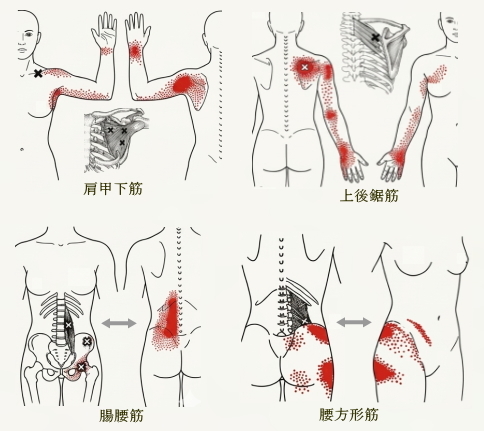 頭痛や首肩こりに関連する筋肉と関連痛（トリガーポイント）を示した図