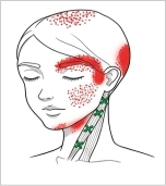 胸鎖乳突筋（胸骨頭）トリガーポイント 目頭やこめかみの痛み
