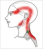 僧帽筋上部線維 トリガーポイント こめかみの痛み
