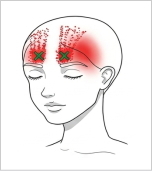 前頭筋 トリガーポイント 額の痛み