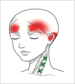 胸鎖乳突筋（鎖骨頭）トリガーポイント 額や耳の痛み