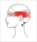 後頭下筋群 トリガーポイント 側頭や痛み