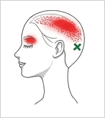 後頭筋 トリガーポイント 頭痛と目の奥の痛み