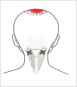 頭板状筋 トリガーポイント 頭頂の痛み