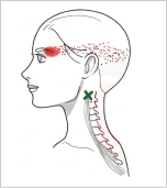 頚板状筋 トリガーポイント 目の奥の痛み