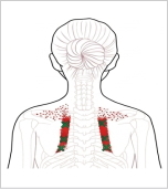 菱形筋 トリガーポイント 肩甲骨の骨ぎわの痛み