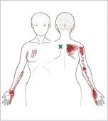 上後鋸筋 トリガーポイント 背中のコリと腕の鈍痛