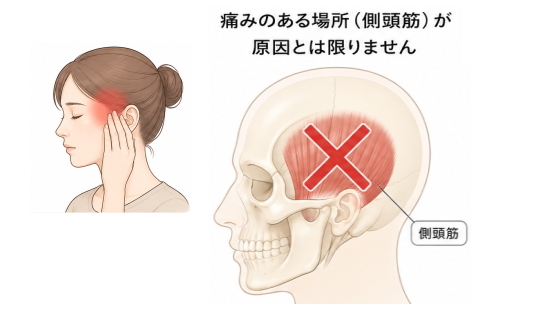 側頭の痛みは側頭筋が原因ではないことを示した図