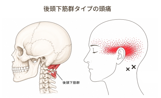 後頭下筋群のトリガーポイントと頭痛の関連図