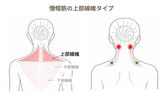 僧帽筋上部線維の関連痛と首の付け根の痛み