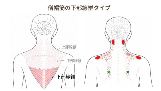 僧帽筋下部線維の関連痛と首の付け根の痛み