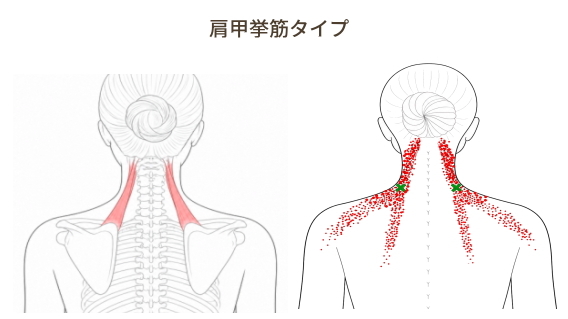 肩甲挙筋の関連痛と首の付け根のコリ