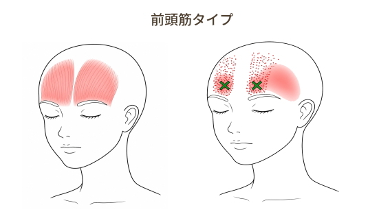 前頭筋の関連痛とおでこの痛み
