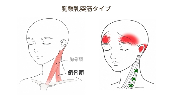 胸鎖乳突筋(鎖骨頭)の関連痛とおでこの痛み