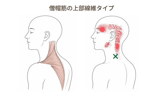 僧帽筋上部線維の関連痛とこめかみの痛み