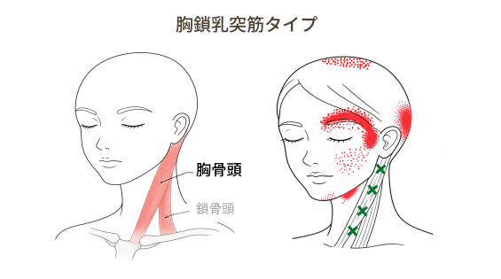 胸鎖乳突筋（胸骨頭）の関連痛とこめかみの痛み