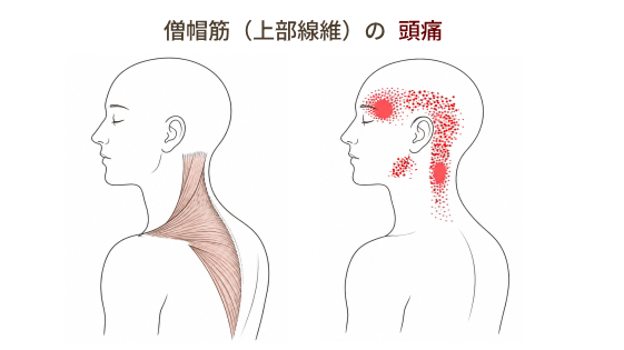 僧帽筋上部線維によるこめかみの頭痛