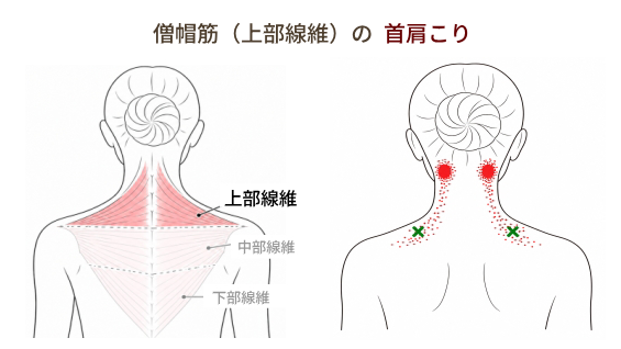 僧帽筋上部線維による首の後ろのコリ