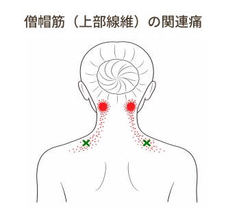 僧帽筋上部線維のトリガーポイント
