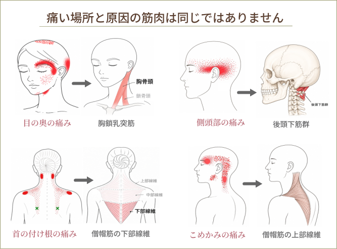 頭痛や肩こりで痛みを感じる場所と原因となる筋肉の違いを示した関連痛のイメージ図