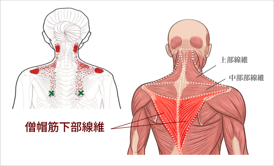 僧帽筋下部線維の位置と首の付け根に現れる関連痛を示した図